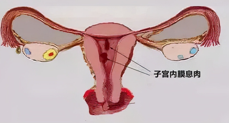 子宫内膜息肉手术费,多发性子宫内膜息肉
