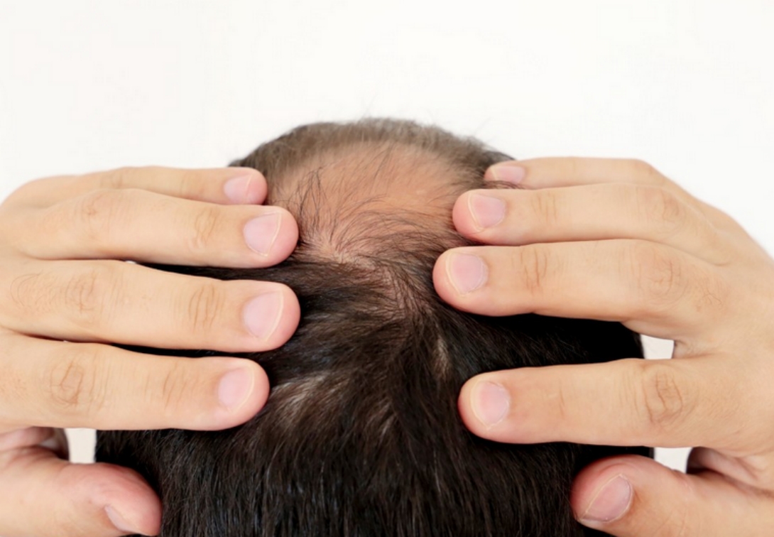 怎么脱发最有效果,怎么样脱发才算严重