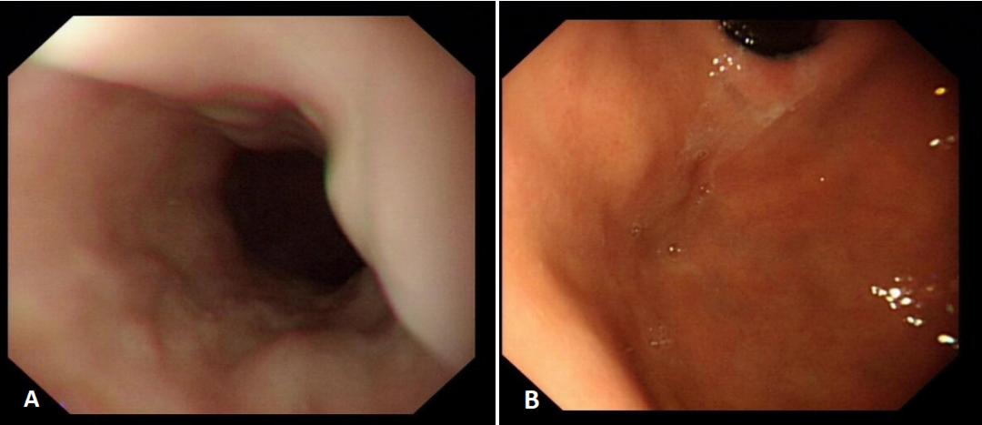 肝硬化失代偿期脾栓塞手术,肝硬化脾脏切除术