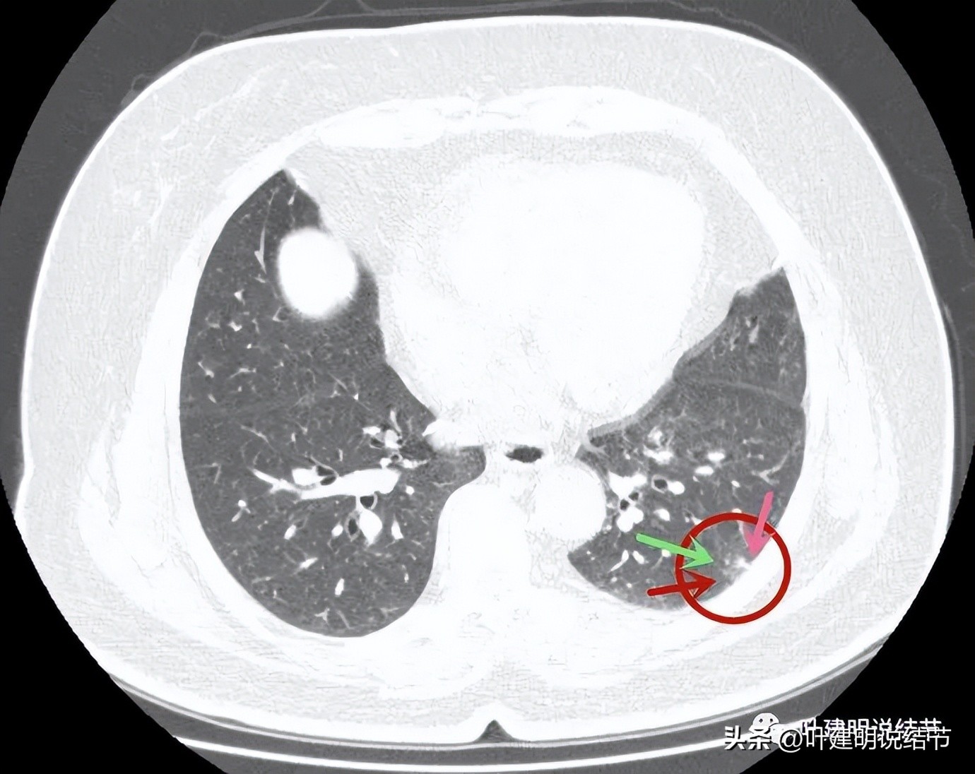 肺结节实性为什么建议抗炎治疗,肺上实性结节抗炎后变成空洞