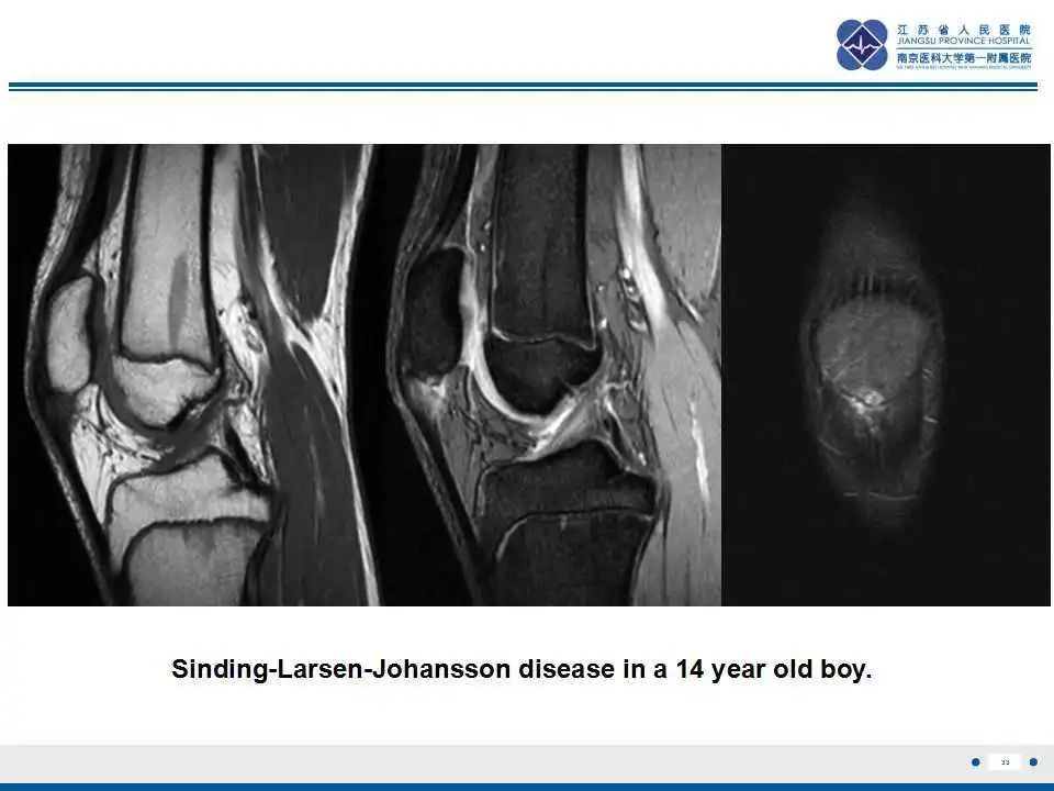 胫骨结节软骨炎要怎么治疗,胫骨结节骨软骨炎会癌变吗
