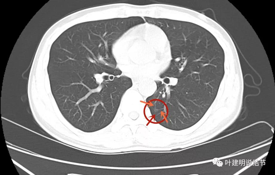 这样的多发病灶给试验性抗结核治疗?消失的结节是药的功劳吗?