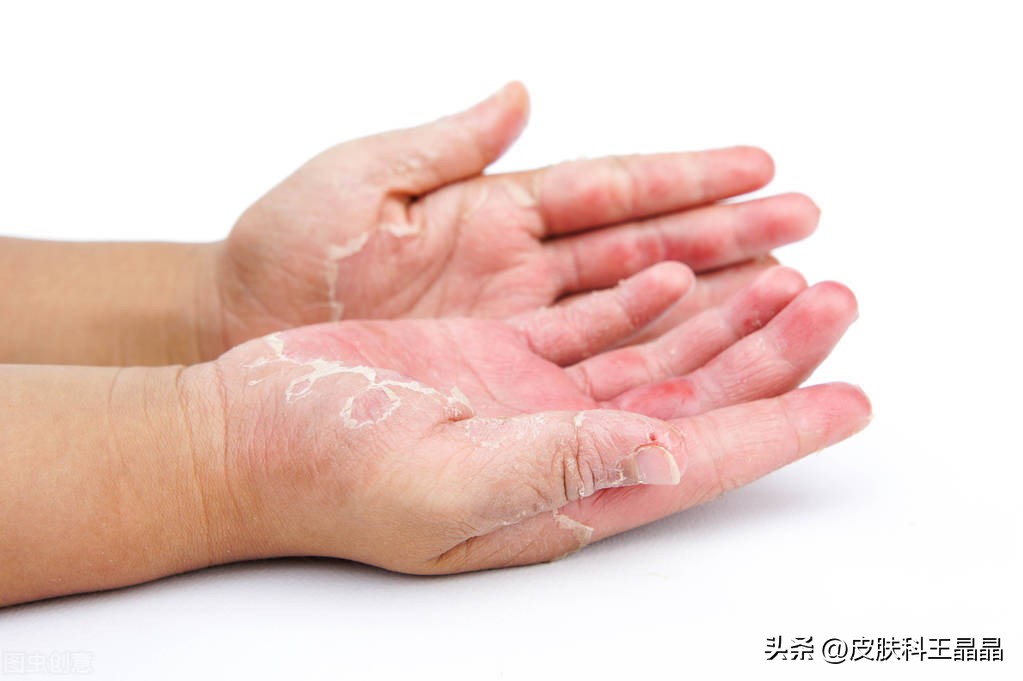 手上长小水泡是脚气吗,水泡型脚气可以传染到手上吗