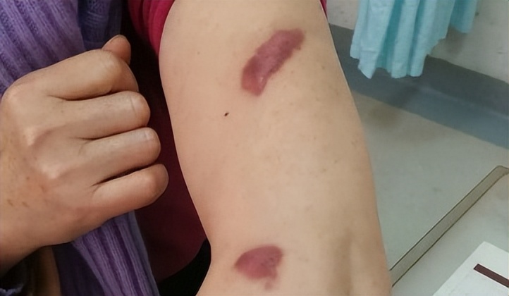 最难愈合的疤痕,无法治愈的疤痕