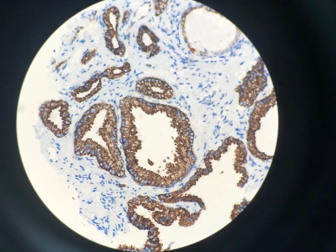 医生说病理报告有点小问题,病理报告没出来好害怕啊