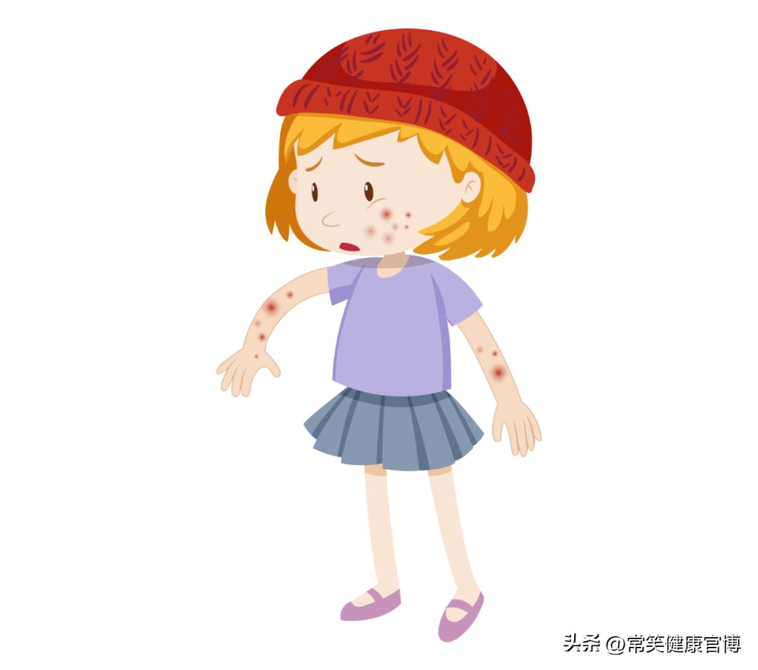 水痘一般是怎么传染的,水痘在什么情况下最容易传染