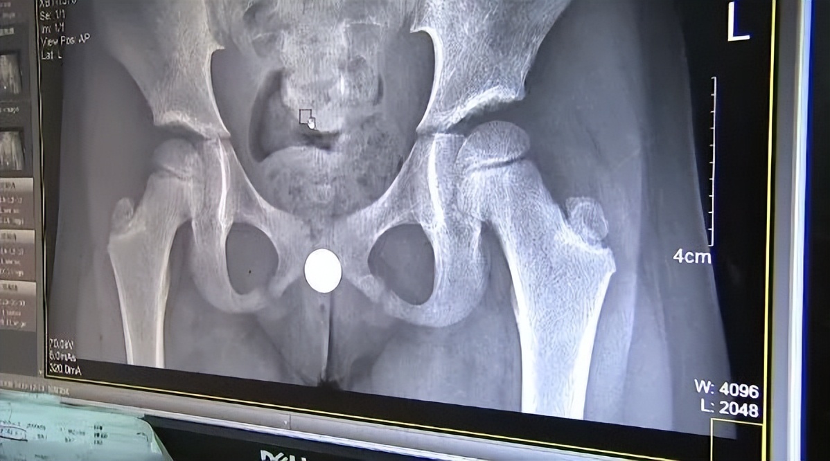 浙江14岁男孩体内取出19颗磁力珠,十一岁男孩吞磁珠