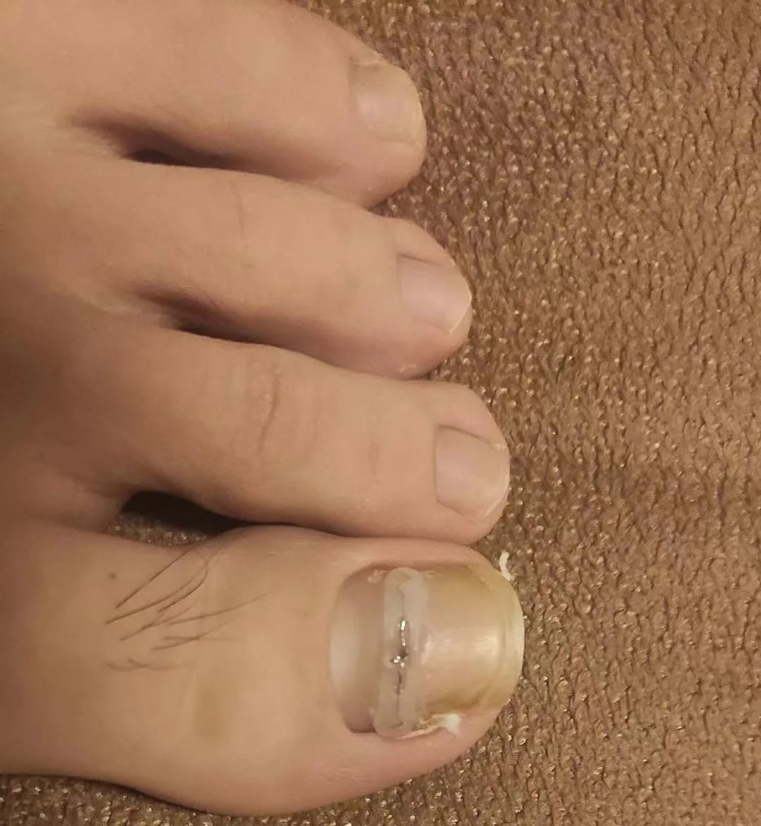 痛痛痛的嵌甲有救了