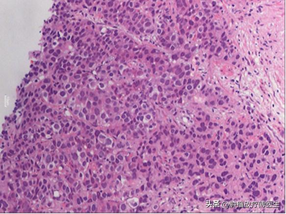 前列腺癌三维适形放疗,前列腺癌放射治疗策略与进展