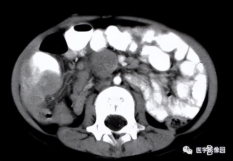 海扶刀很好吗,海扶刀为啥叫海扶刀