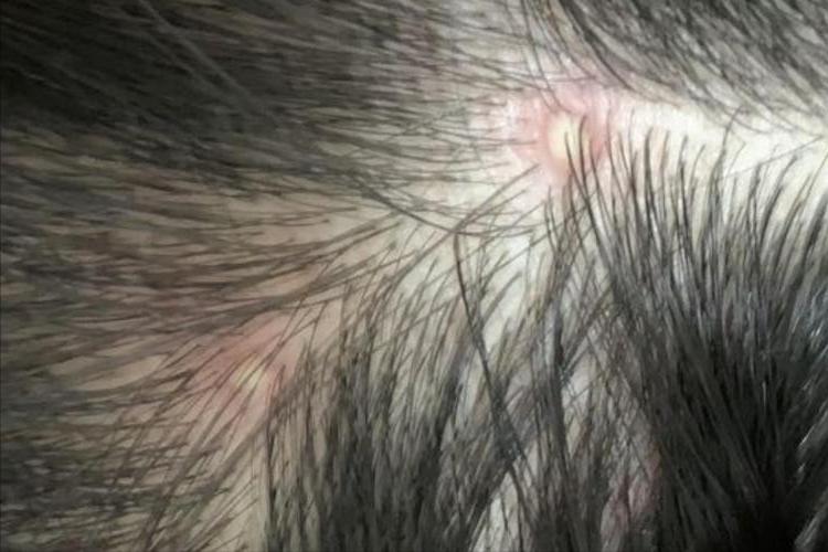 头皮长疙瘩和脓包怎么回事,头皮长脓包是怎么回事啊