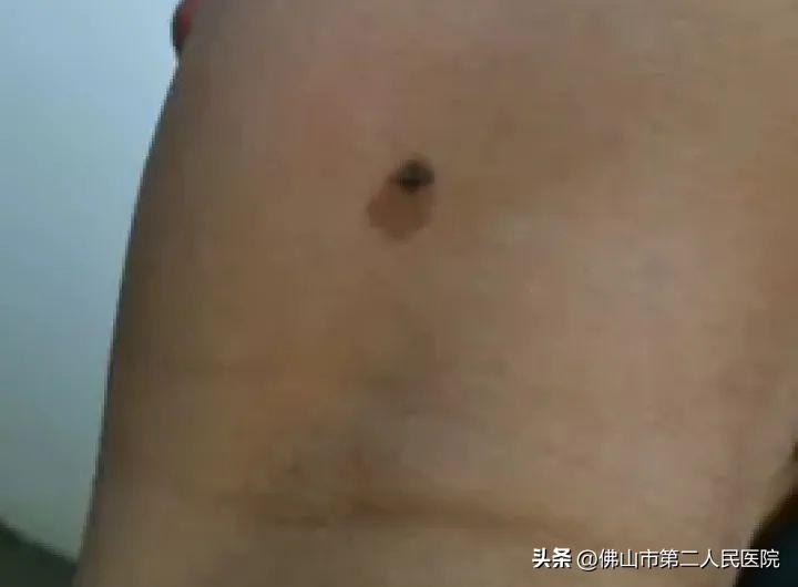 年轻歌手得黑色素瘤去世,歌手黑痣和黑色素瘤的区别