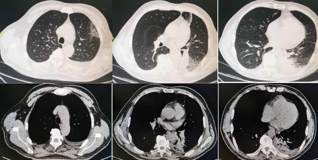 反复发烧但是拍片显示轻微肺炎,一直高烧39-40是肺炎么