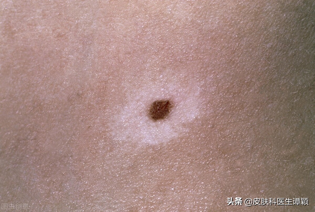 皮肤科医生谈白癜风,皮肤科医生谈论变白