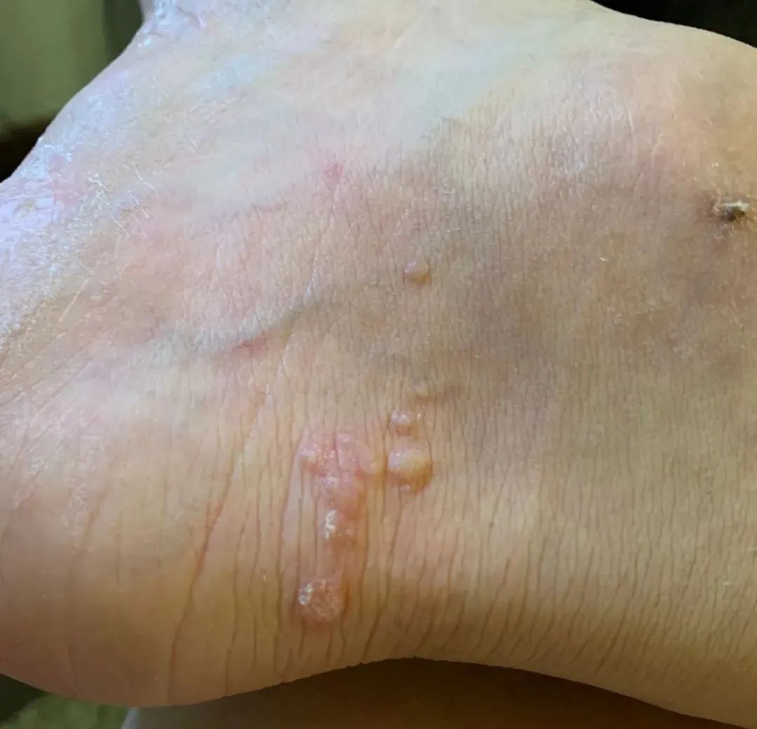 hpv和疣是一种病吗,hpv病毒疣是什么样的