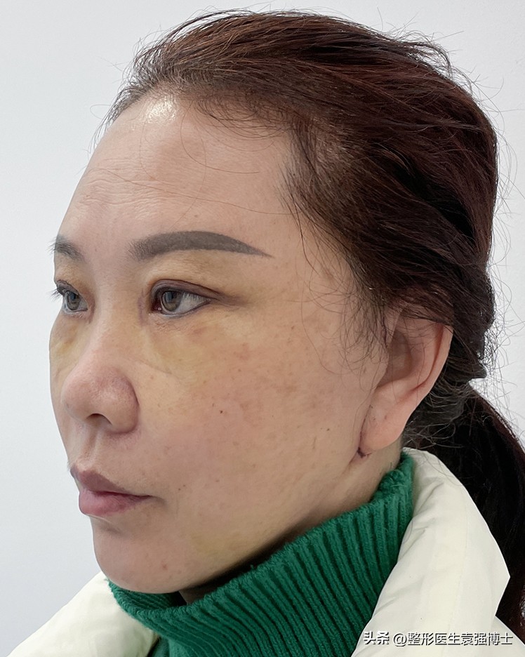 拉皮手术后7天效果图,拉皮手术术后恢复注意事项