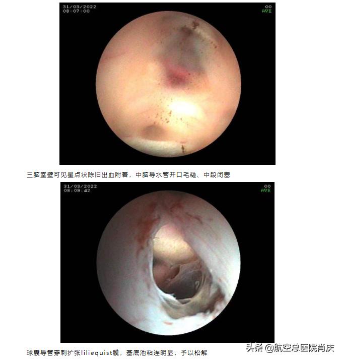 内镜治疗脑积水成功率多大,早产儿脑积水适合神经内镜手术吗