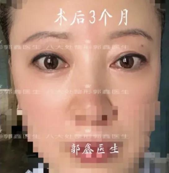 56岁做眼袋手术,眼袋手术的真实感受