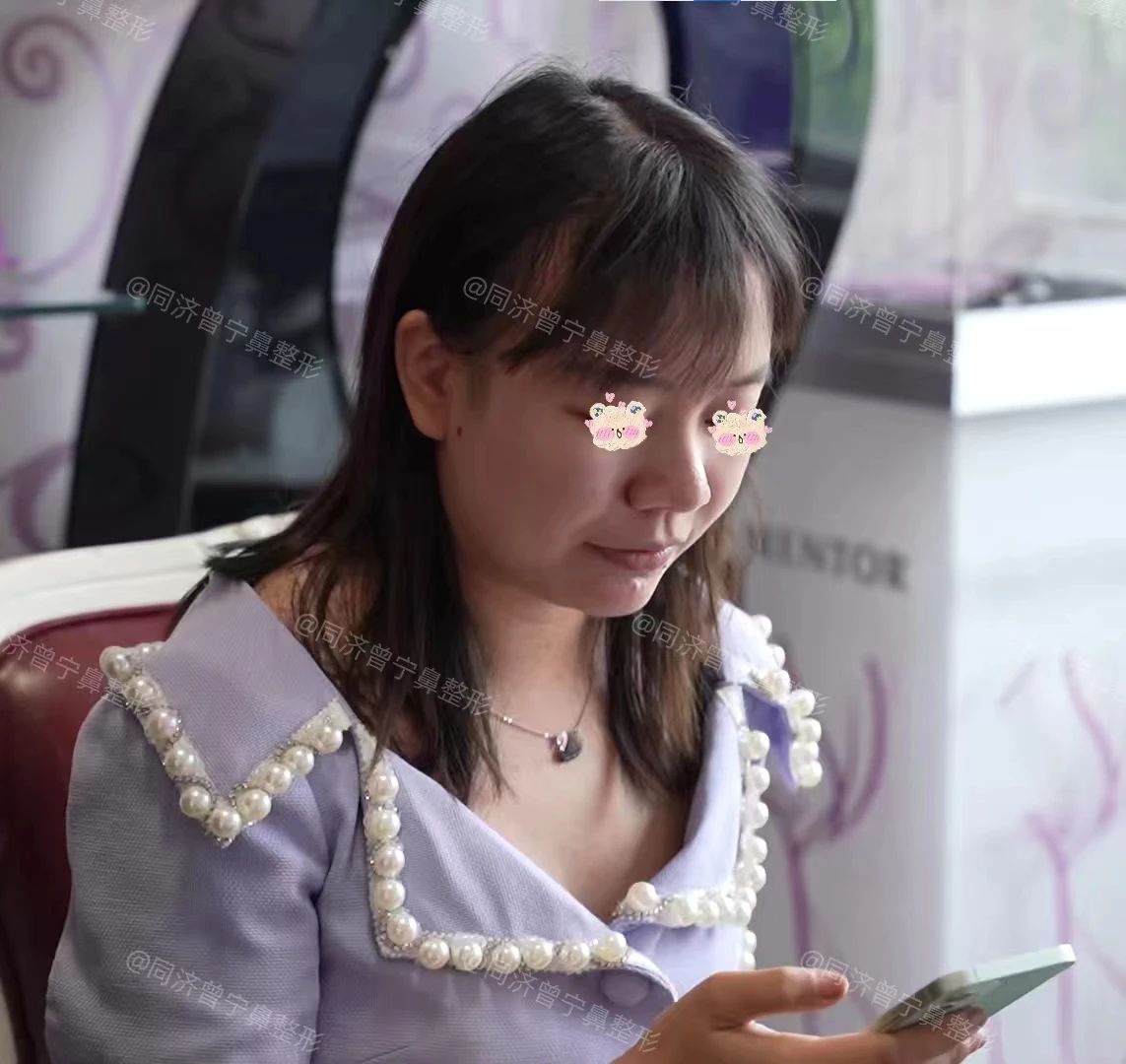 蒜头鼻鼻头大怎么改善,鼻头肉怎么改善鼻型