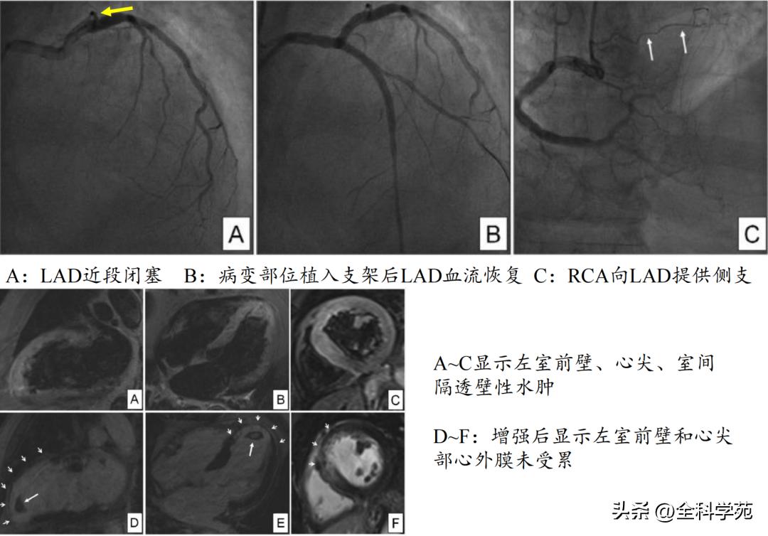 t波高尖心电图判断标准,t波高尖判断标准