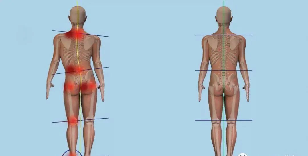 长短腿的原因和解决方法,长短腿引起症状该怎么处理
