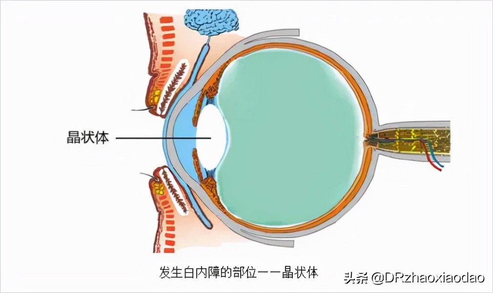 眼药水对真性近视有用吗,美国研究一种新眼药水能治老花眼