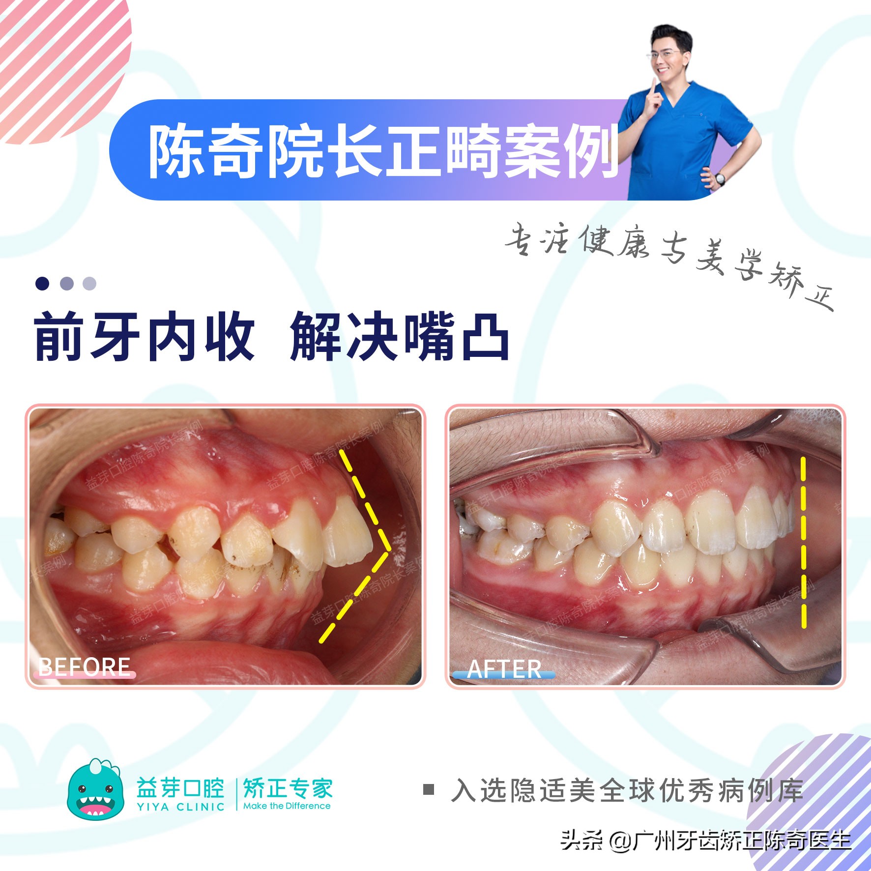 11岁女孩牙齿前突需要扩弓吗,16岁女生上颌骨前突矫正