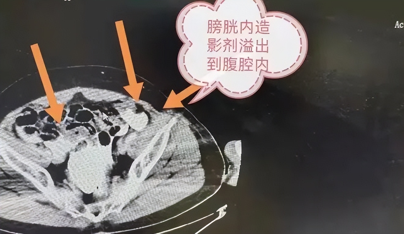 女性身体构造很特殊，憋尿的危害更大！