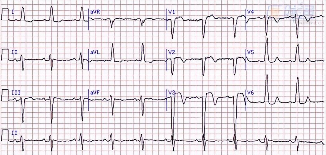 惊恐发作的治疗和自救有哪些方法,焦虑症惊恐发作时自己如何处理