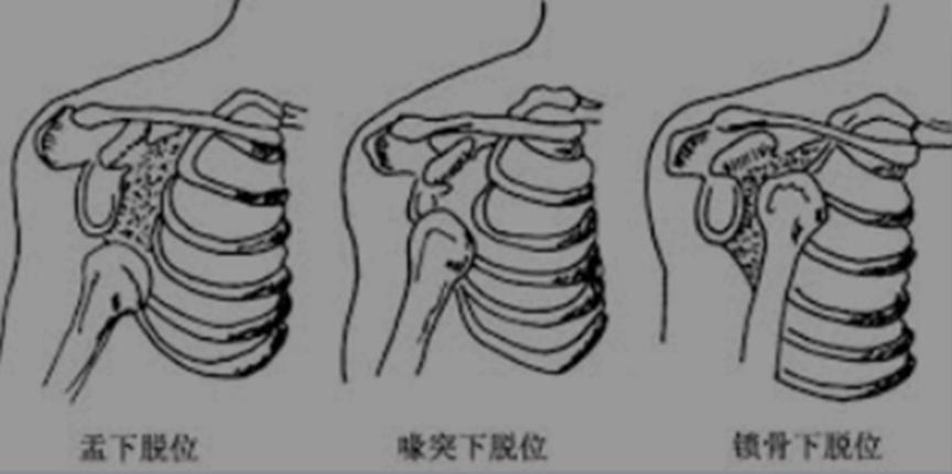 如何避免肩关节脱位，肩关节脱位是怎么造成的？