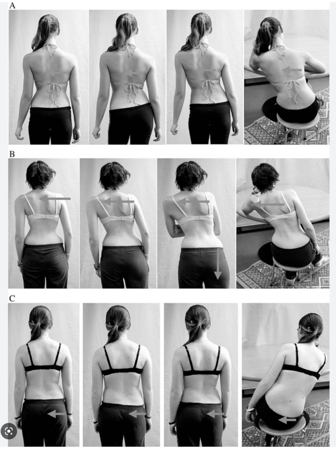 成人脊柱侧弯往哪弯,成年人脊柱侧弯怎么矫正