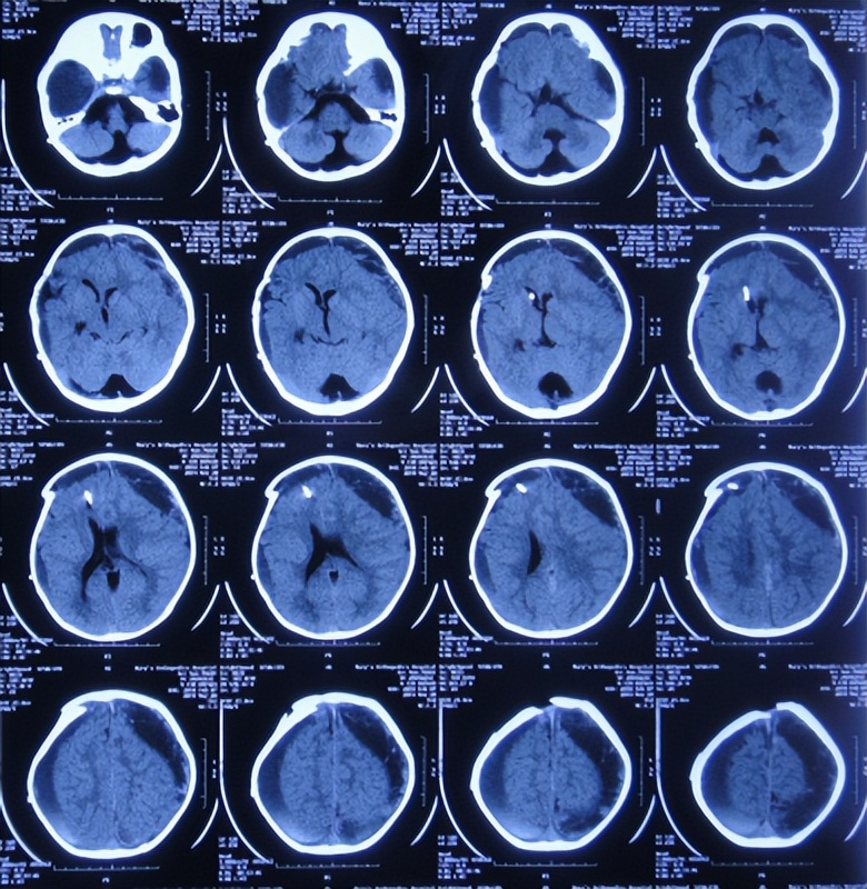 蛛网膜囊肿合并脑积水腹腔分流术,治疗蛛网膜囊肿引起脑积水严重吗
