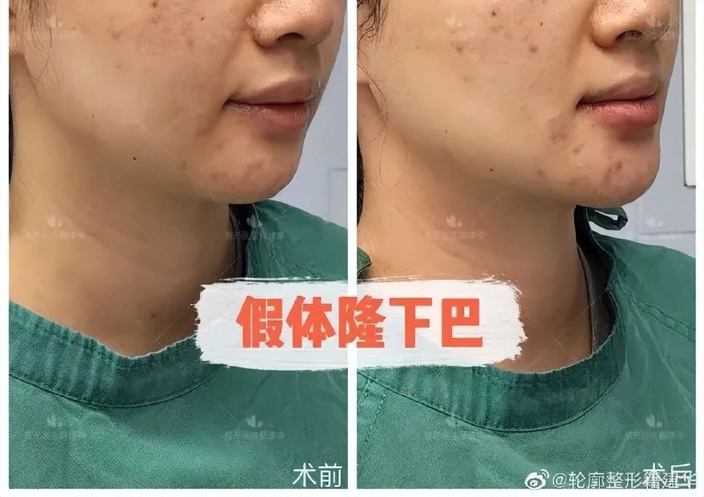 下巴后缩是不是最难看的,下巴后缩明星怎么改善