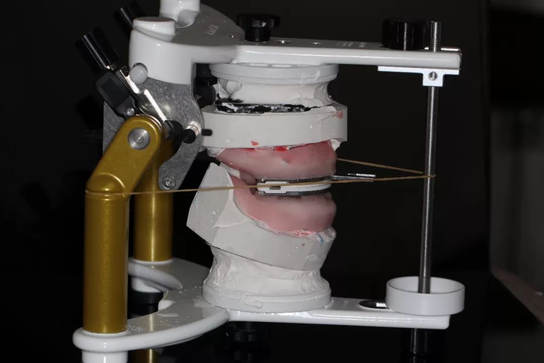 干货分享口腔,全口义齿是怎样做的