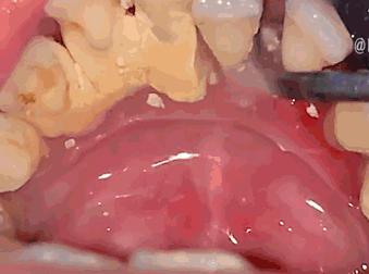 牙结石不处理是不是越长越多,牙结石一个月能长多少