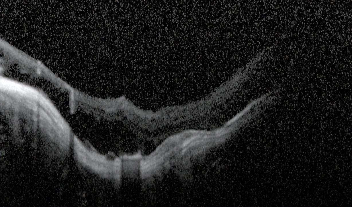 这样“破烂”的超高度近视眼底，还有手术价值吗？