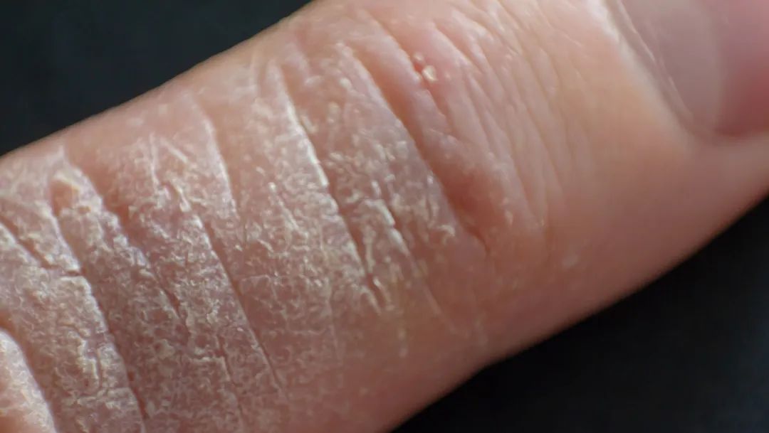 手掌起水泡怎么区分湿疹汗疱疹,反复汗疱疹脱皮