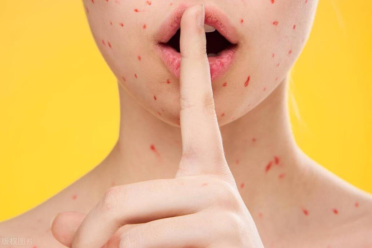 过敏性紫癜属于什么类皮肤病,过敏性紫癜皮肤病吃扑尔敏可以吗