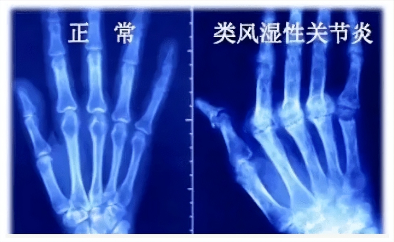 重庆市痛风专家高锋,高锋医生