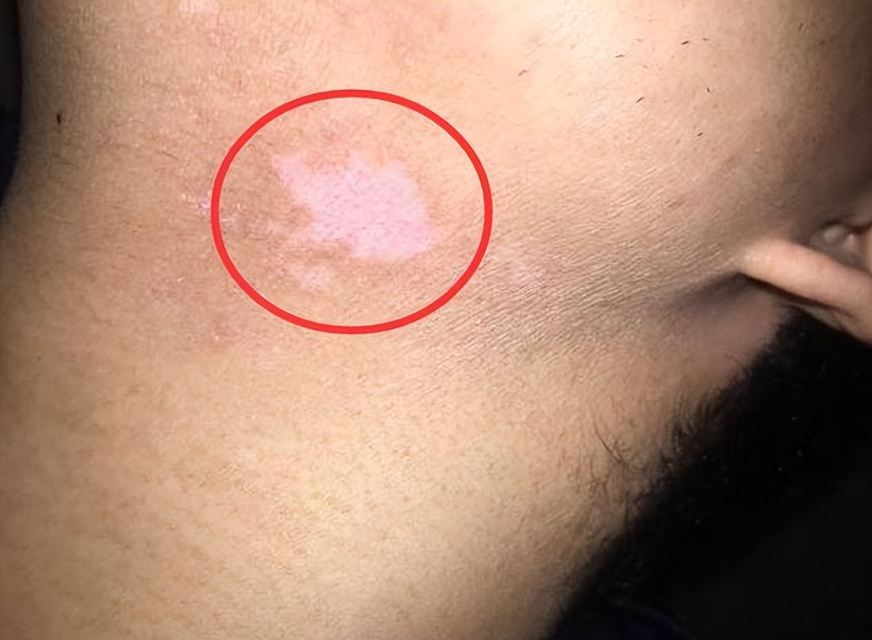 孩子脸上长白斑怎么解释,孩子脸上长白斑一定是白癜风吗