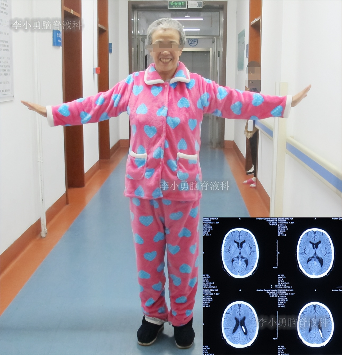 脑积水手术后4天还呕吐怎么回事,脑积水分流术后一直腹部疼痛