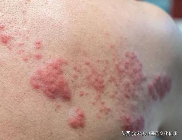 带状疱疹病例中医诊断,中医刺血预防带状疱疹