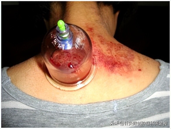 颈部淋巴结节消除的药,颈部淋巴结肿大不消除