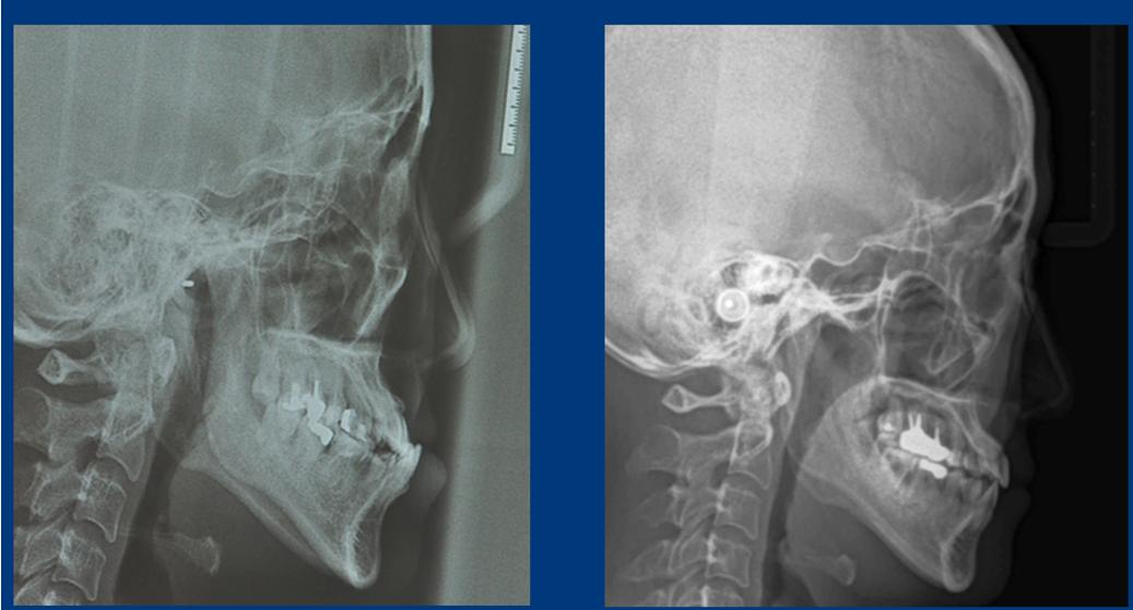 地包天能做手术矫正吗,儿童地包天矫正几岁做最好