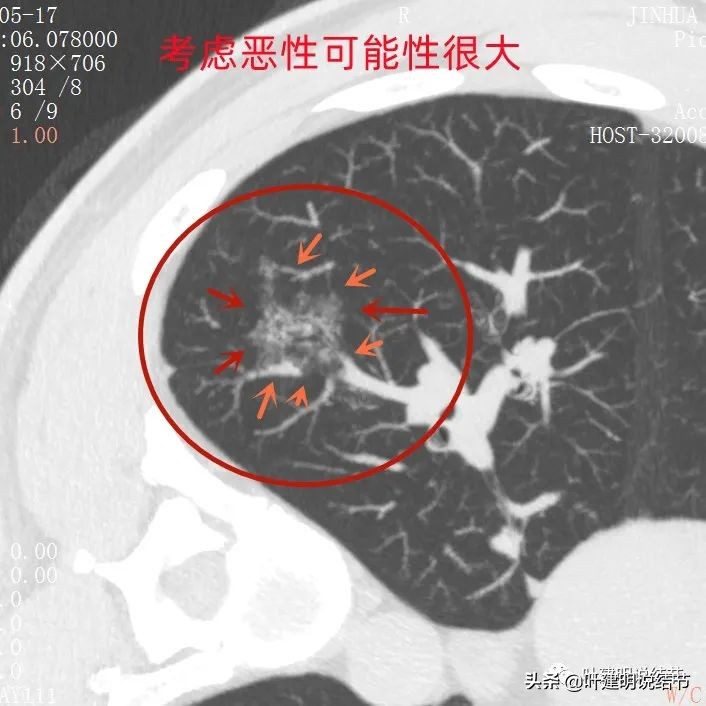 肺蜂窝状改变是肺癌吗,肺部陈旧灶与肿瘤怎么确诊