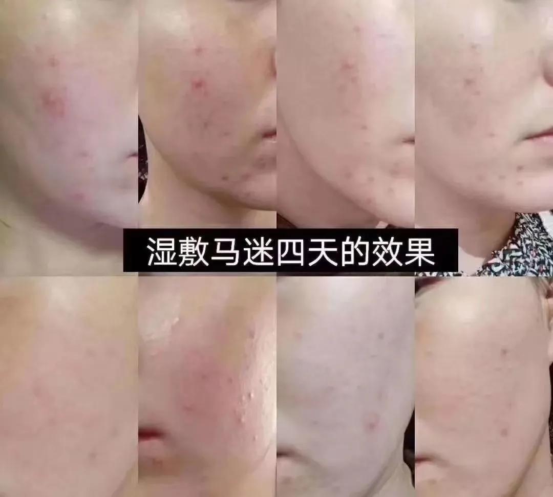 脸上毛孔闭合怎么疏通,疏通毛孔清洁毛囊祛粉刺的方法