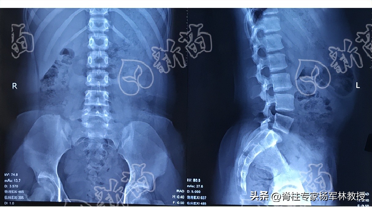 x光片不清晰是拍摄人员的问题吗,x光片可能会拍错吗