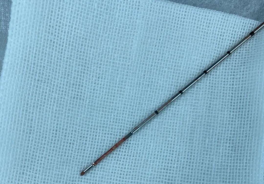 萌娃长肿瘤，“穿刺”定乾坤——郑大三附院成功实施超声引导下肝脏肿瘤穿刺活检术