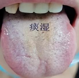 舌根部有裂纹是什么舌象,舌有裂纹7种原因通过舌象来调理