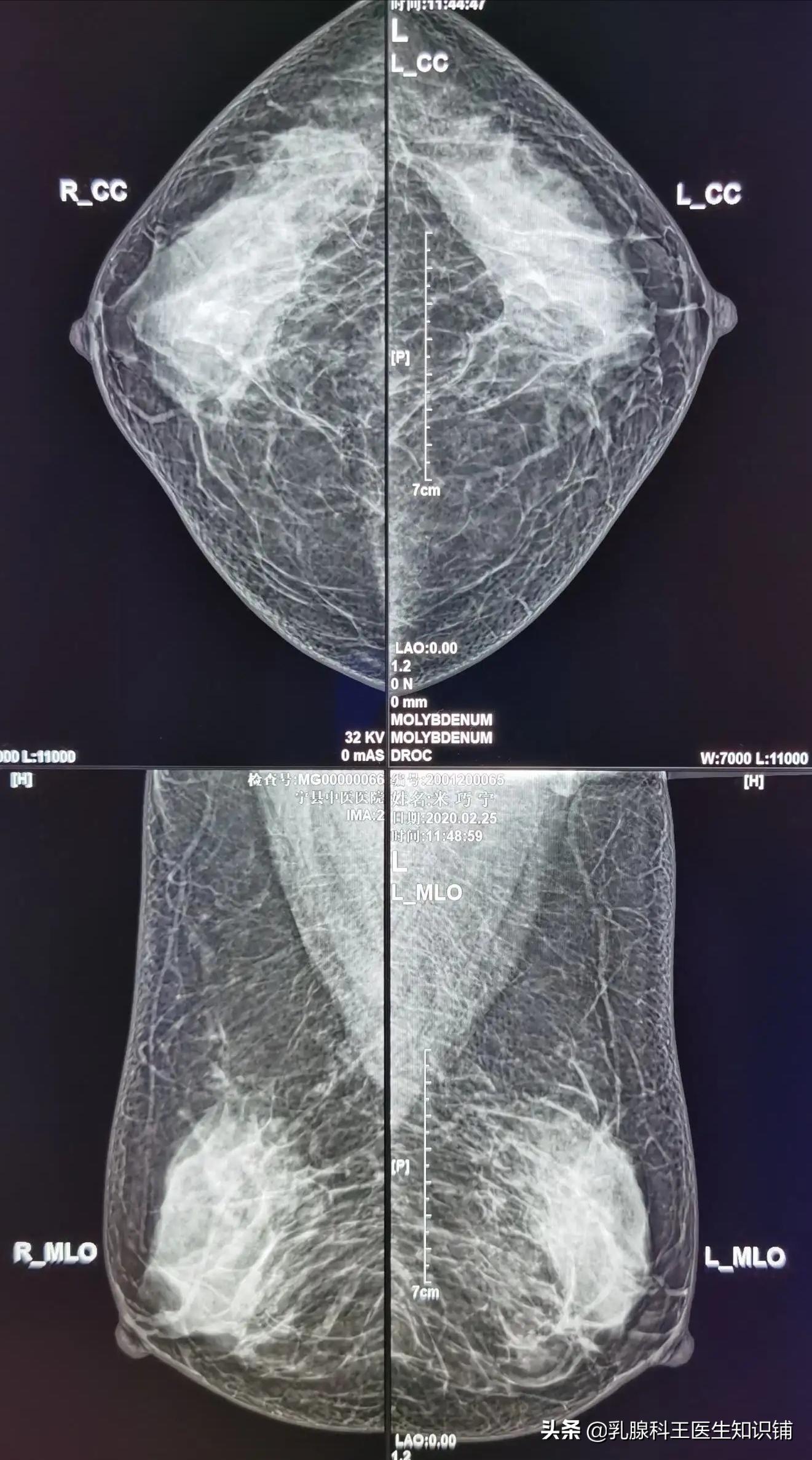 乳头出现溢液你需要进行这些检查、治疗和预防(下)